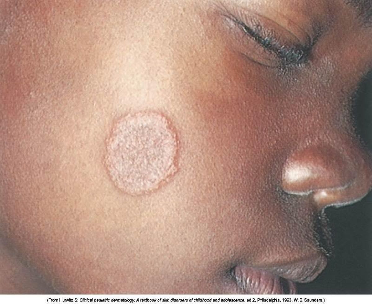 Can You Have Herpes From Sharing Clothes at Delores Peterson blog