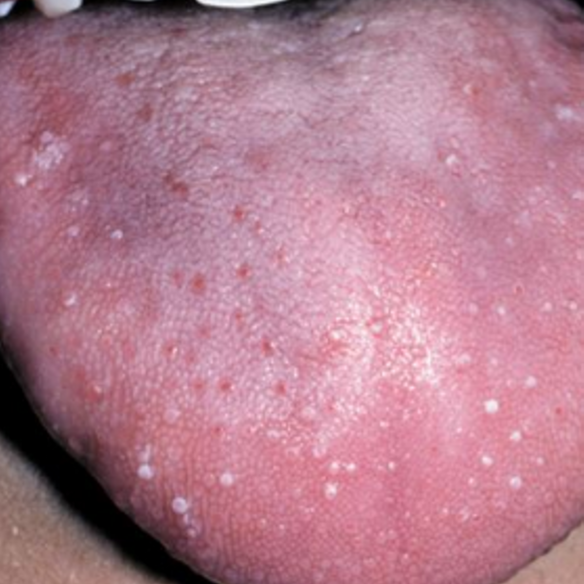 3 Causes Of Tongue Bumps