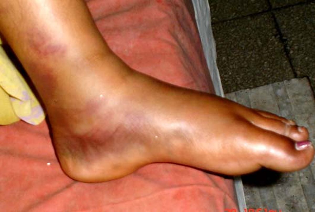 5 causes of swollen feet, ankles