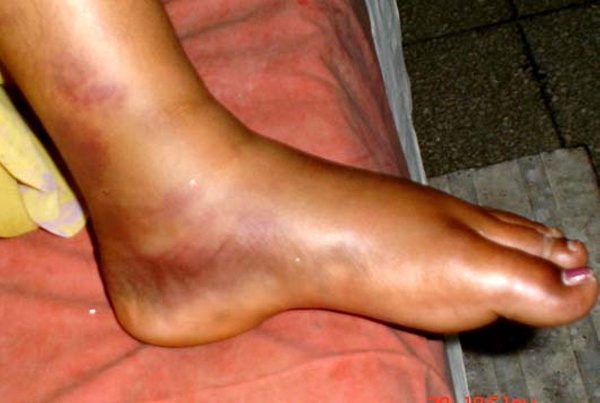 12-causes-of-swollen-ankles-feet-why-are-my-ankles-swollen