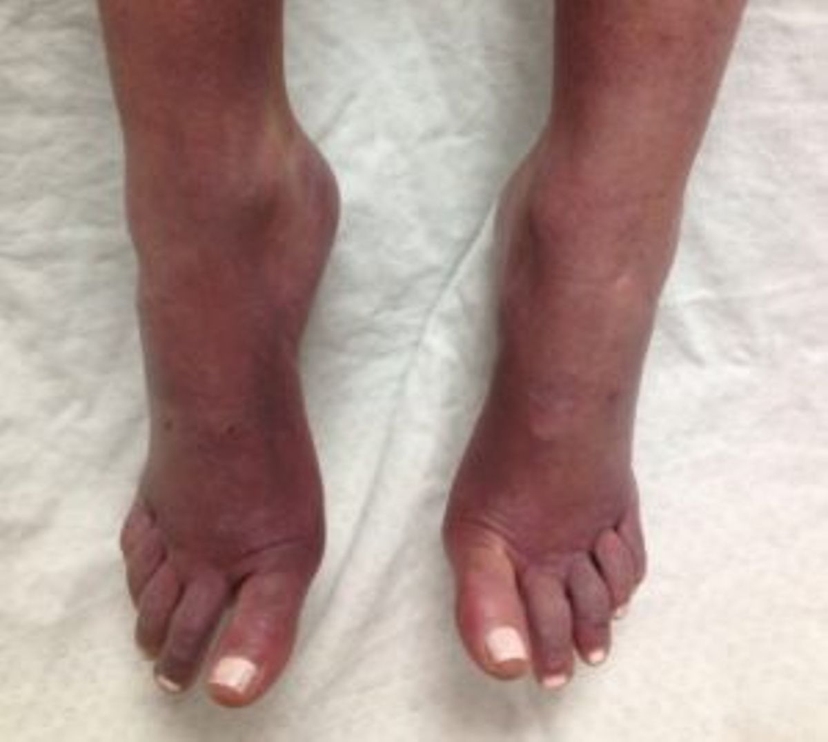 Five causes of swollen feet in women