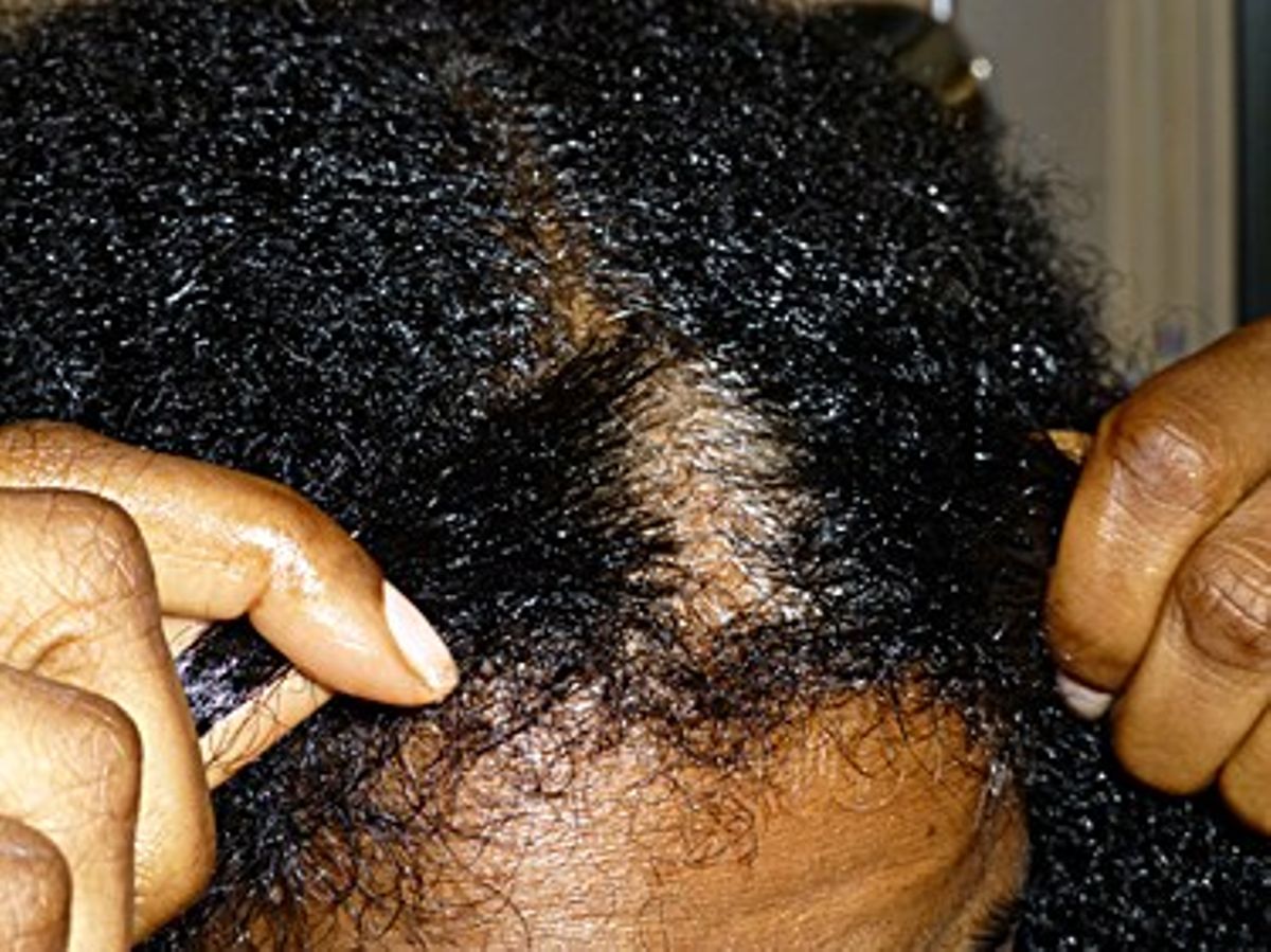how-to-get-rid-of-dandruff-on-your-head