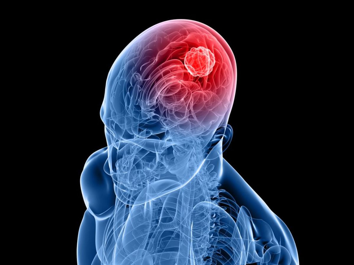 Early signs of brain tumor in adults