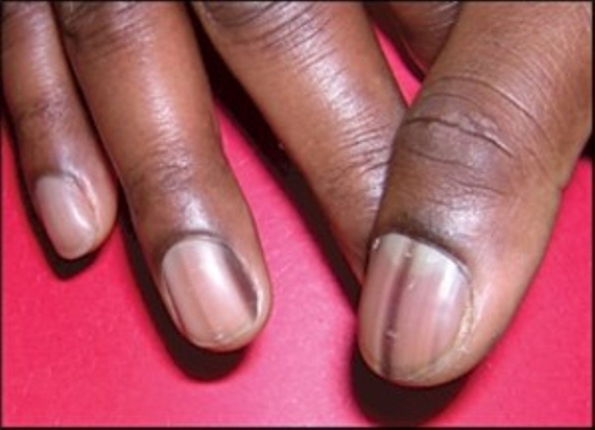 What your fingernails say about your health