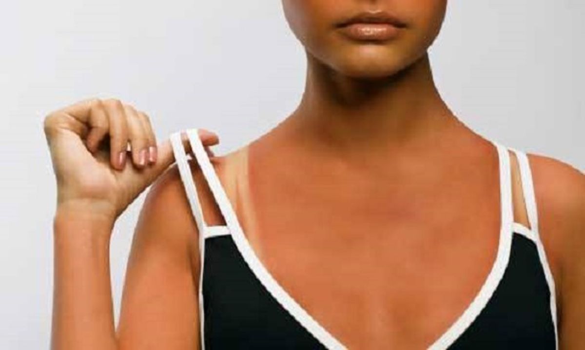 Four ways to get rid of bra strap marks naturally