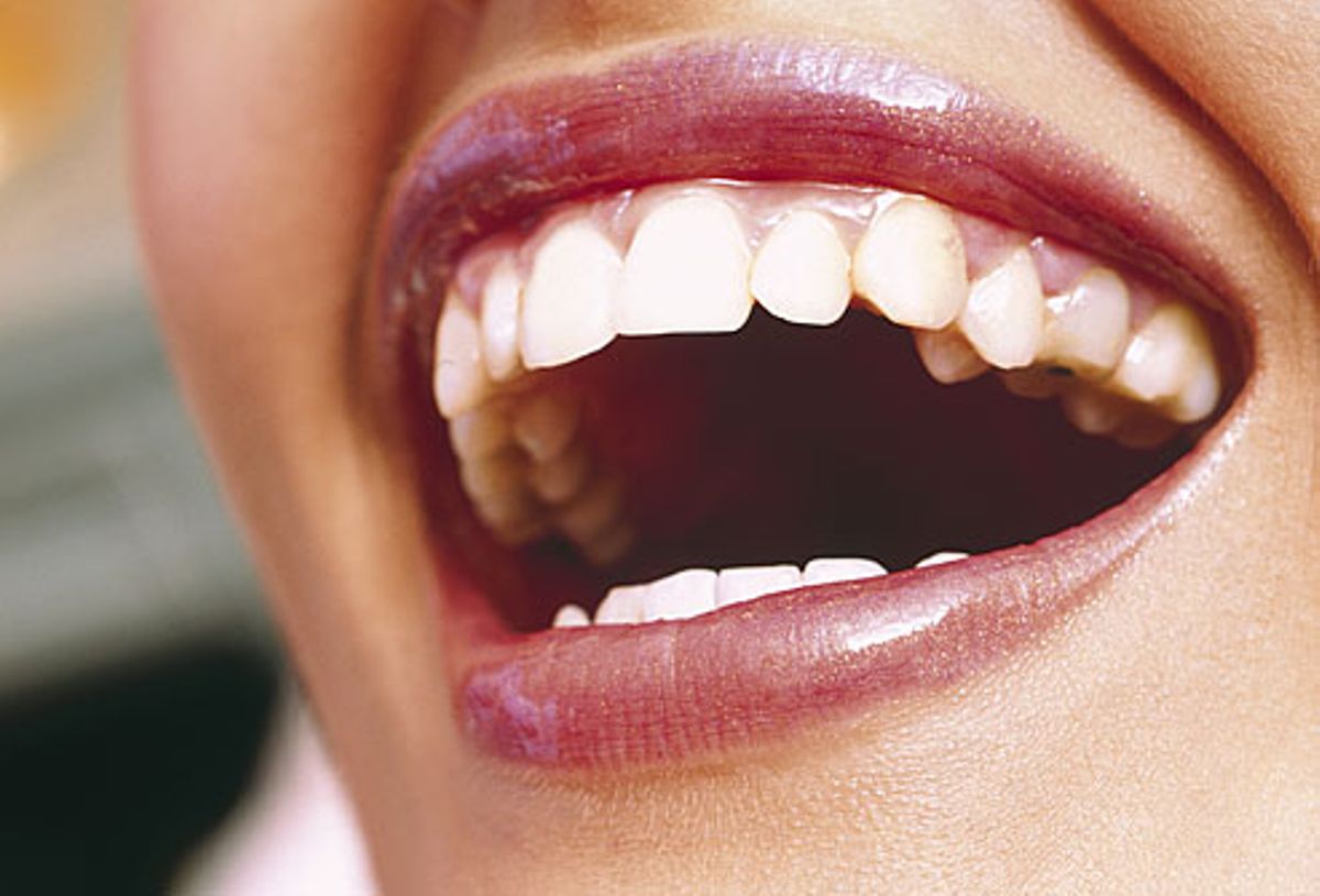 What Causes Brown Stains On Back Of Teeth