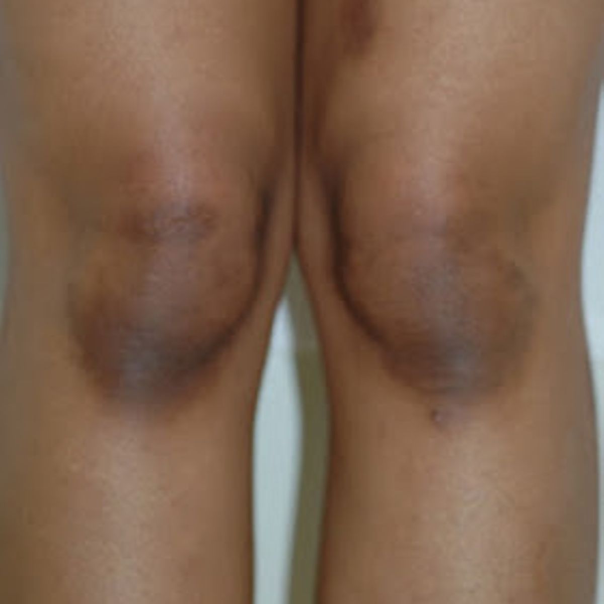Causes of dark elbows and knees and how to prevent them